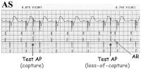 Abbildung 2: Schrittmacher - Atrial Chamber Reset