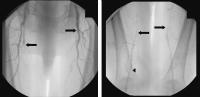 Abbildung 1: Arteria femoralis superficialis - Stent