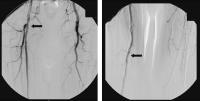 Abbildung 3: Arteria femoralis superficialis - Stent