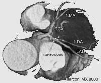 Figure 1: Koronarangiographie - Multislice CT