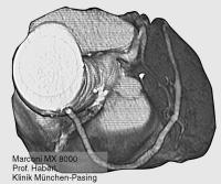 Figure 2: Koronarangiographie - Multislice CT