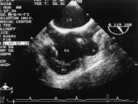 Figure 2: Rechtsatrialer Appendix
