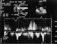 Figure 3: Rechtsatrialer Appendix