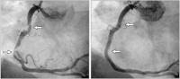 Abbildung 4: Koronarangiographie - Stenose - Stent