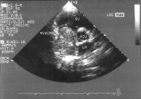 Figure 1: Atriales Myxom