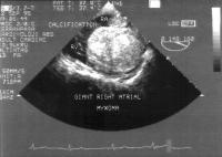 Figure 2: Atriales Myxom