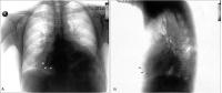 Figure 1A-B: Mediastinale Masse