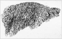 Figure 1: Atherektomie