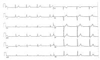 Figure 1: Emery-Dreifuss Muskeldystrophie - Kardiopathie