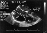 Figure 2: Emery-Dreifuss Muskeldystrophie - Kardiopathie
