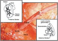 Abbildung 2: Anastomosendevices