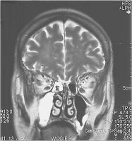 Abbildung 1: Sinusitis