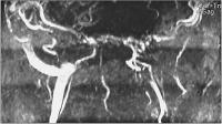 Abbildung 3: Vena jugularis - Thrombose