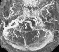 Abbildung 5: Sinus sigmoideus - Rekanalisation