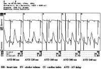 Figure 1: Impedanzkardiographie - AV-Intervall