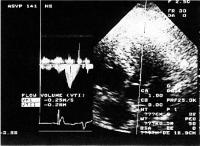 Figure 2: Echokardiographie - AV-Intervall