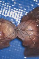 Abbildung 3: Vasovasostomie - Mukosa