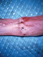 Abbildung 4: Vasovasostomie - Muscularis - Adventitia