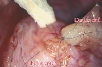 Abbildung 5: Tubulovasostomie - Mukosa - Muscularis - Serosa
