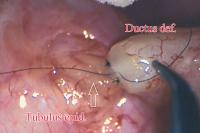 Abbildung 6: Tubulovasostomie - Mukosa - Tubulus