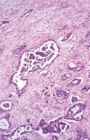 Abbildung 1: Mesonephroides Adenokarzinom