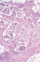 Abbildung 2: Mesonephroides Adenokarzinom