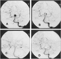 Abbildung 6: Aneurysma - Coil