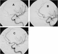 Abbildung 7: Aneurysma - Papaverin - Ballon-Angioplastie