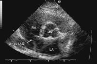 Abbildung 1: Interatriales Septum - Aneurysma