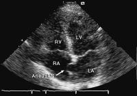 Abbildung 2: Interatriales Septum - Aneurysma