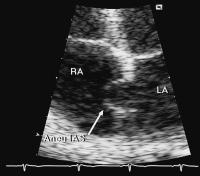 Abbildung 3: Interatriales Septum - Aneurysma