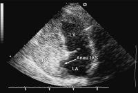 Abbildung 4: Interatriales Septum - Aneurysma