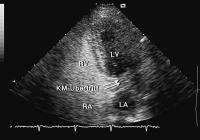 Abbildung 5: Interatriales Septum - Aneurysma
