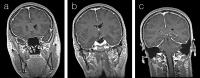 Abbildung 1a-c: Hypertrophe chronische Pachymeningitis