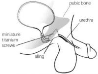 Abbildung 5: In-Vance-System
