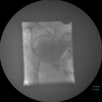 Abbildung 7: Scott-Spinkter-Implantation - Insuffizienter Blasenhals