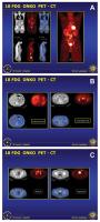 Abbildung 1: FDG-PET-CT
