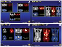 Abbildung 3: 18F-Cholin-PET-CT