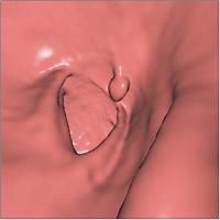 Abbildung 1-a: Sigma - 9 mm Polyp