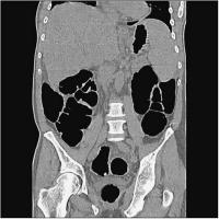 Abbildung 1-b: Sigma - 9 mm Polyp