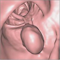 Abbildung 2-a: Colon descendens - Polyp