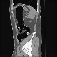 Abbildung 2-b: Colon descendens - Polyp