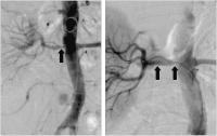Abbildung 1: Perkutane Angioplastie - Stentimplantation