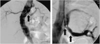 Abbildung 2: Perkutane Angioplastie  - Stentimplantation