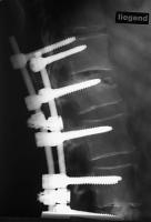 Abbildung 3-a: Kyphoplastie - Augmentationstechnik
