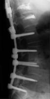 Abbildung 3-b: Kyphoplastie - Augmentationstechnik
