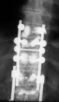 Abbildung 3-d: Kyphoplastie - Augmentationstechnik