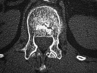 Abbildung 4-b: Zementverteilung - Postoperativ