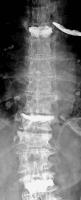 Abbildung 3: Vertebroplastien - Kyphoplastie