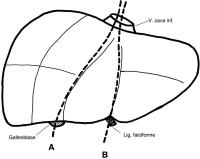 Abbildung 4: Hemihepatektomie - Lobektomie